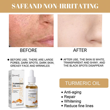 30ml Turmeric Oil Skin To Lightening Acne Dark Patches