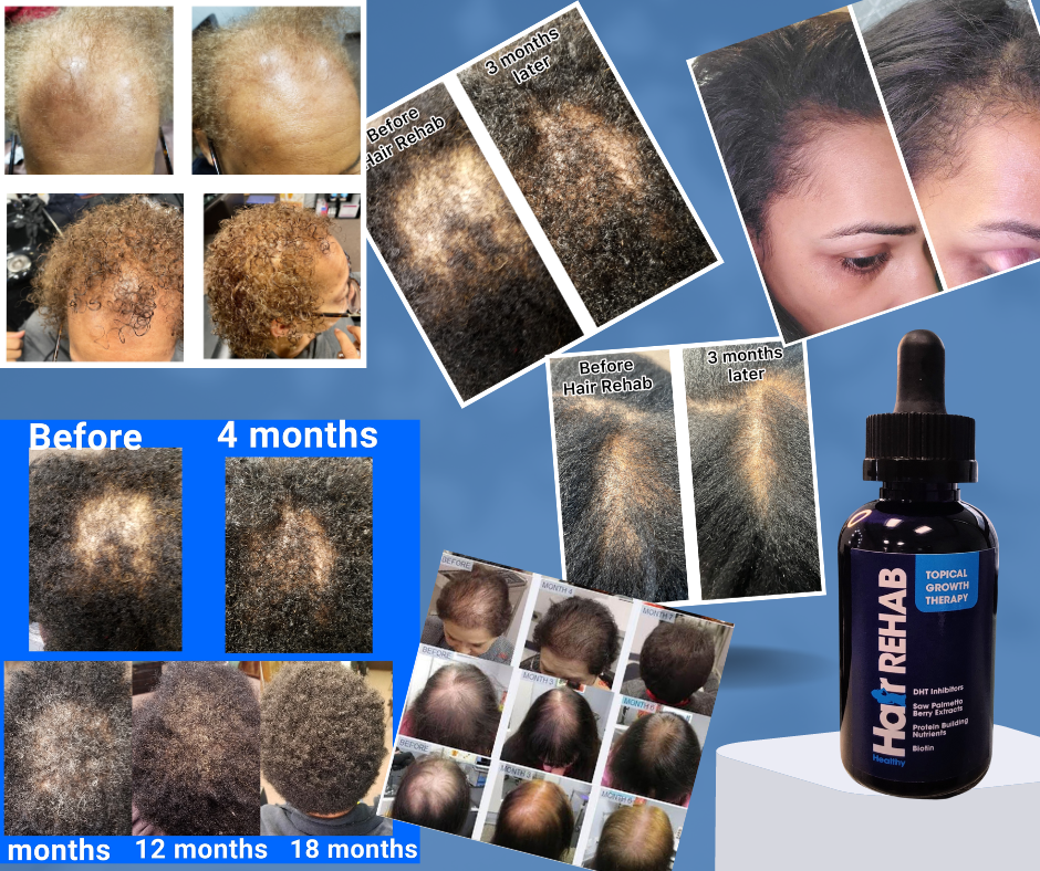 Topical Growth Therapy for Hair Loss Treatment | DHT Blockers, Saw Palmetto, Protein Building Nutrients